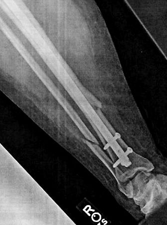 Rose's adamantium leg